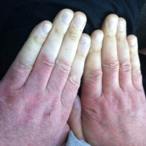Hand-Arm Vibration Syndrome (HAVS)